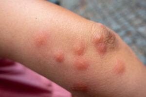 bedbug bites